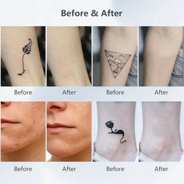 Professional LED Picosecond Pen for Tattoo Removal and Pigment Correction - Image 7